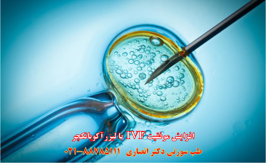 افزایش موفقیت IVF با طب سوزنی لیزری و لیزر گوش