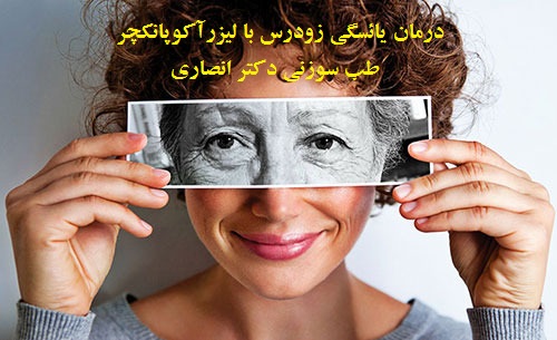 نمونه بالینی درمان یائسگی زودرس با طب سوزنی لیزری بدن و گوش