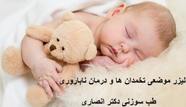 لیزر موضعی، راهی برای بهبود عملکرد تخمدان ها
