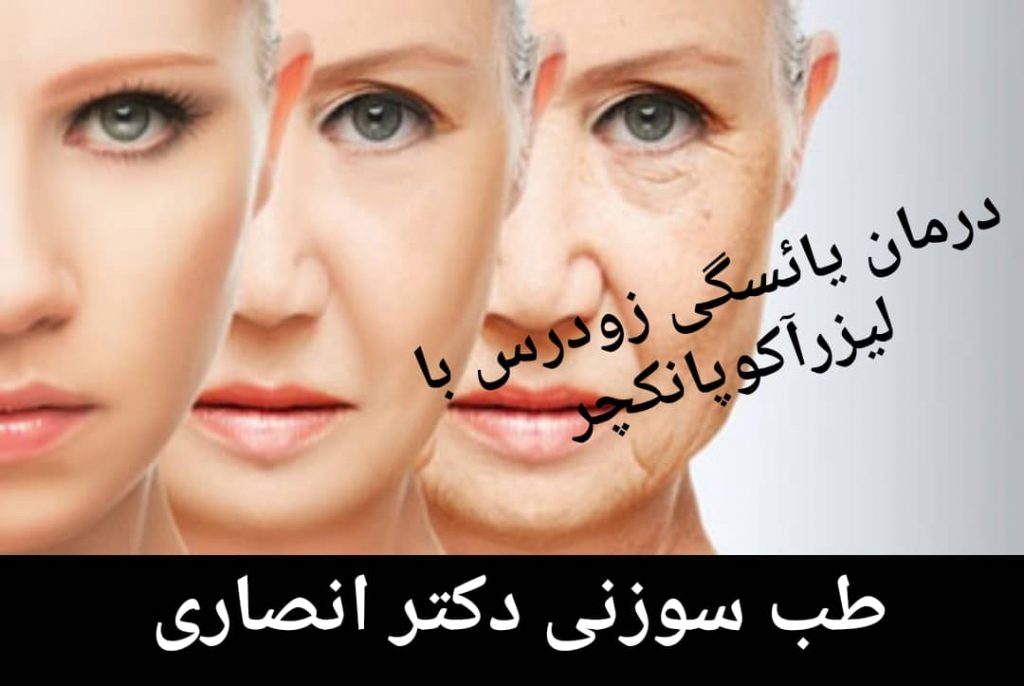 لیزرآکوپانکچر و درمان نارسایی زودرس تخمدان لیزرآکوپانکچر و درمان نارسایی زودرس تخمدان