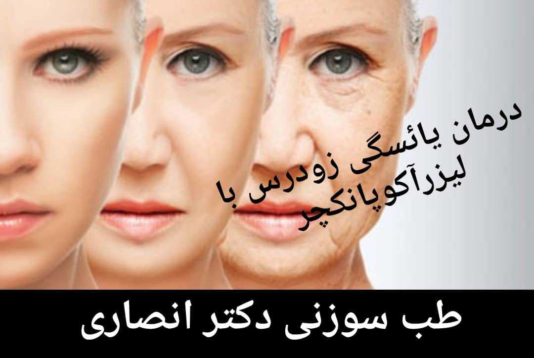 لیزرآکوپانکچر و درمان نارسایی زودرس تخمدان
