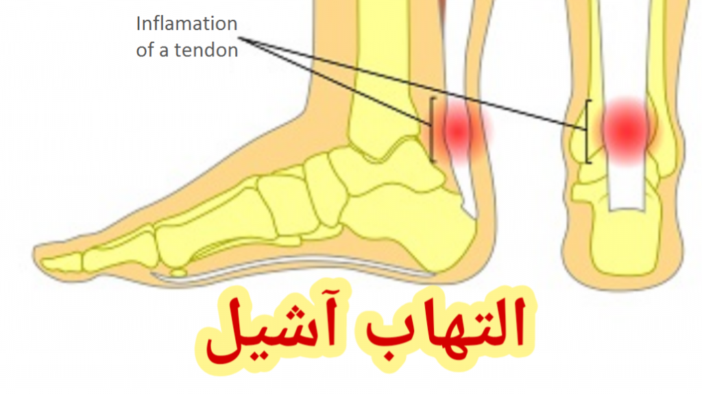 التهاب آشیل و طب سوزنی لیزری التهاب آشیل و طب سوزنی لیزری