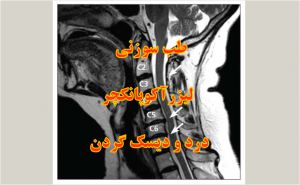 درد و دیسک گردن