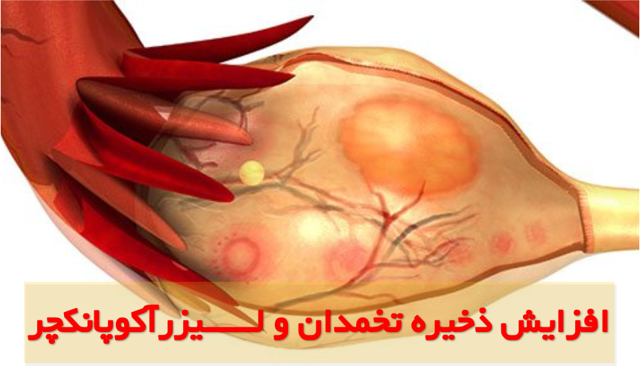 راه های افزایش ذخیره تخمدان راه های افزایش ذخیره تخمدان