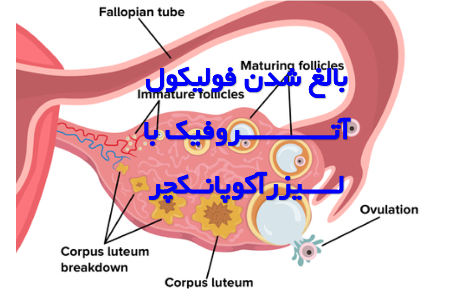 افزایش ذخیره تخمدان و تشکیل فولیکول در یائسگی زودرس