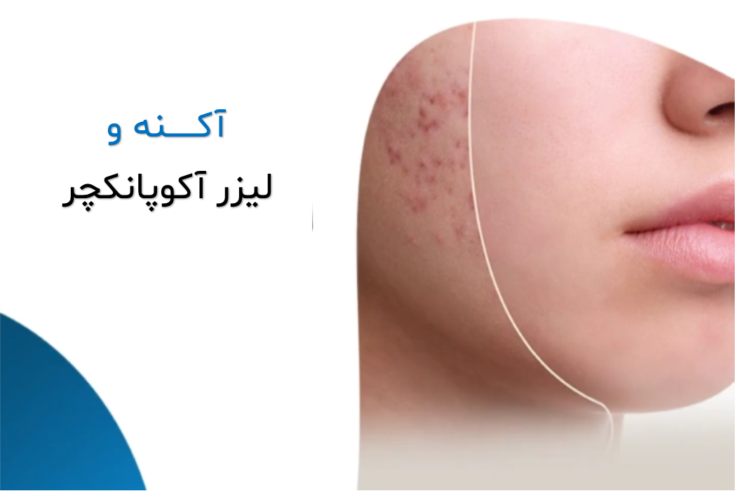 آکنه و مشکلات پوستی