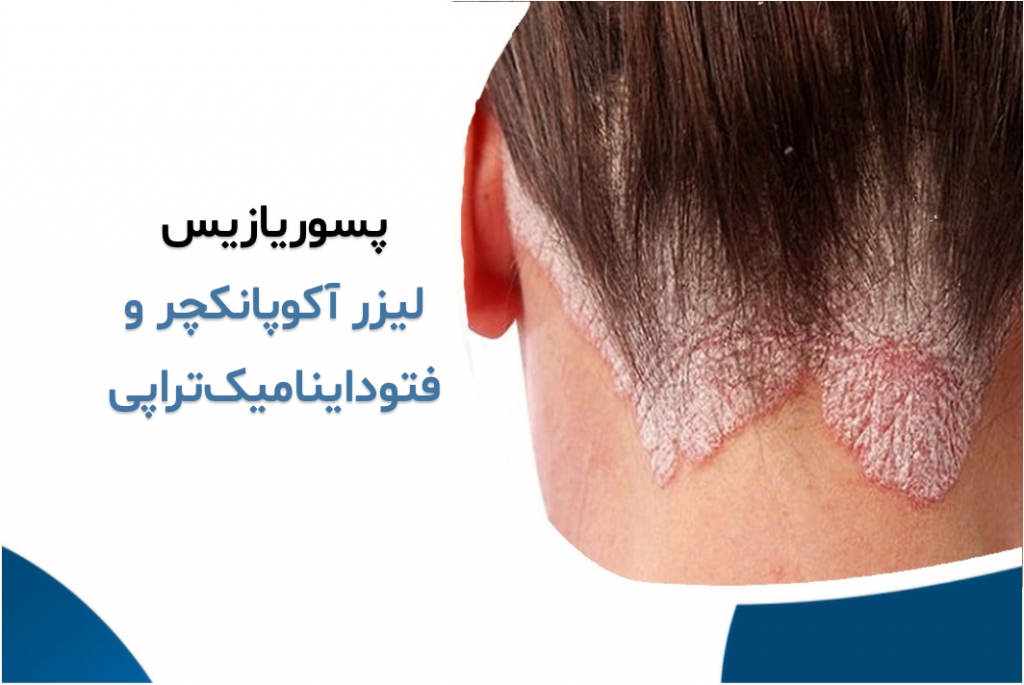 پسوریازیس و خارش شدید پوست پسوریازیس و خارش شدید پوست
