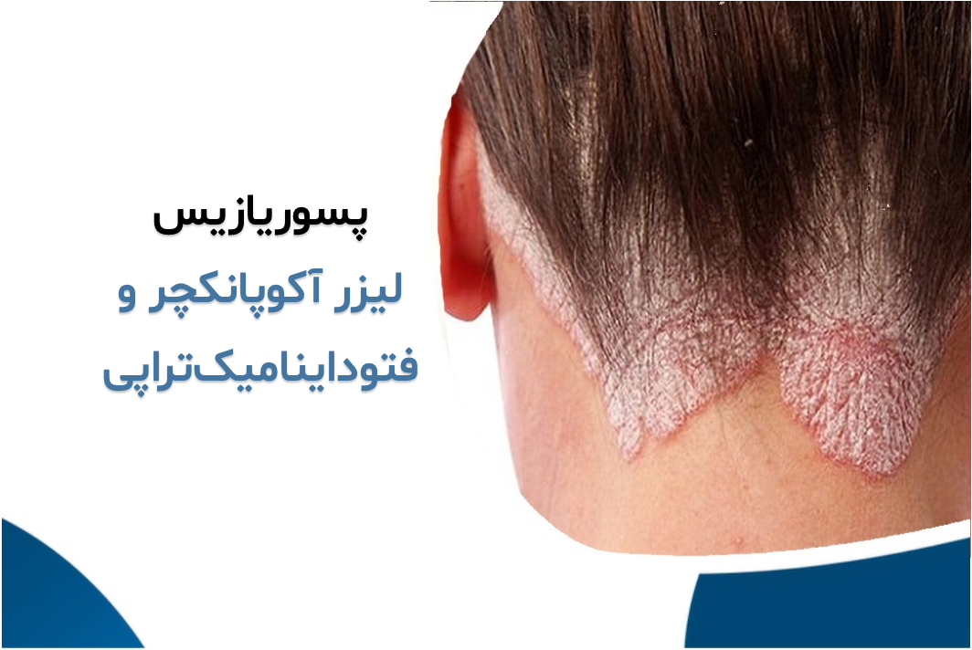 پسوریازیس و خارش شدید پوست