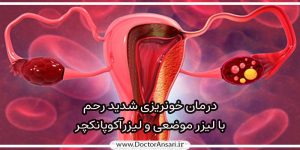 درمان خونریزی شدید پریود (منوراژی یا هایپرمنوره)