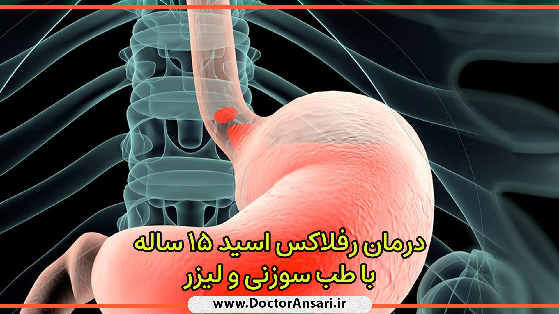 درمان رفلاکس مزمن 15 ساله