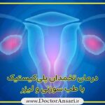 درمان تخمدان پلی کیستیک (PCOs) درمان تخمدان پلی کیستیک (PCOs)