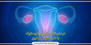 درمان تخمدان پلی کیستیک (PCOs) درمان تخمدان پلی کیستیک (PCOs)